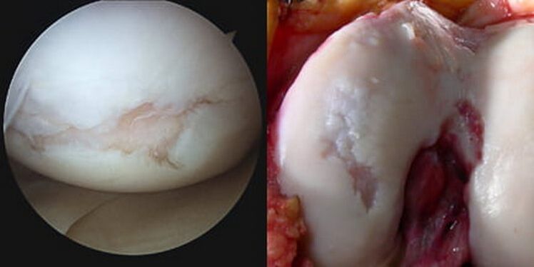 beschadiging van het kniegewricht is zichtbaar tijdens de operatie