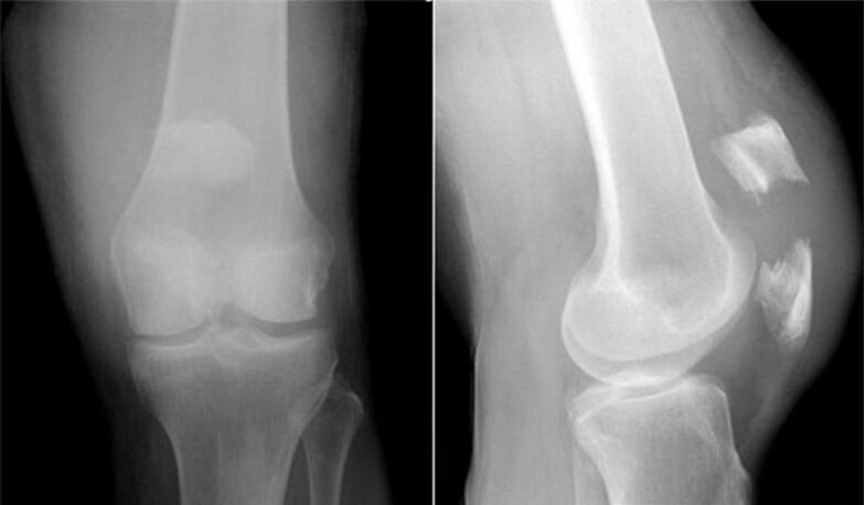 röntgenfoto van de knie
