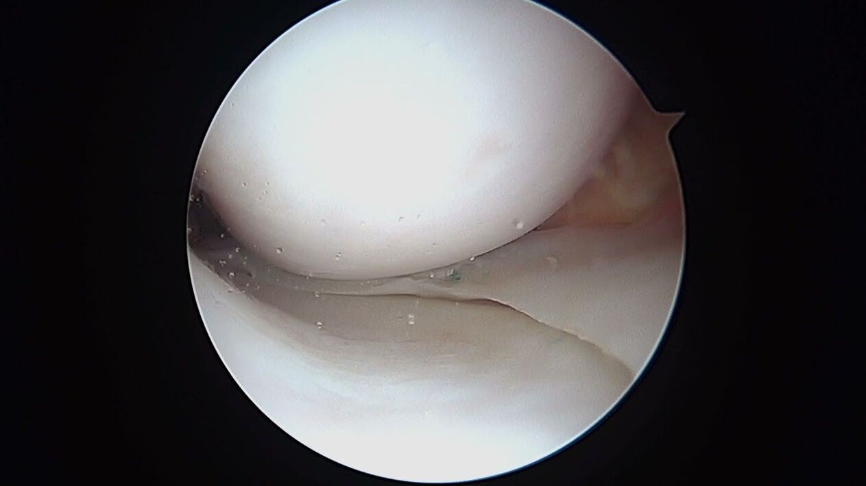 zicht op het kniegewricht door de artroscoop