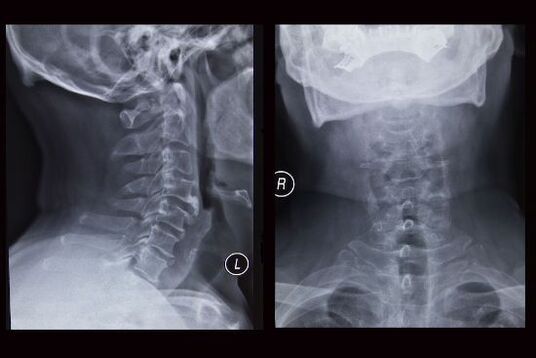 Röntgenfoto van de cervicale wervelkolom (de patiënt heeft osteochondrose)