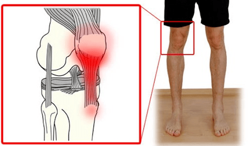 Tendinitis is een ontsteking van het peesweefsel die pijn in het kniegewricht veroorzaakt. 