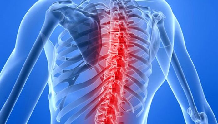 Wervelkolompathologieën zijn de meest voorkomende oorzaken van rugpijn in het schouderbladgebied