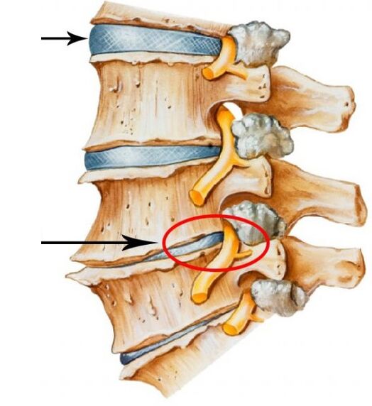 cervicale osteochondrose
