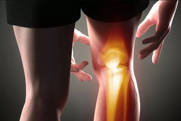 Arthrose van het kniegewricht