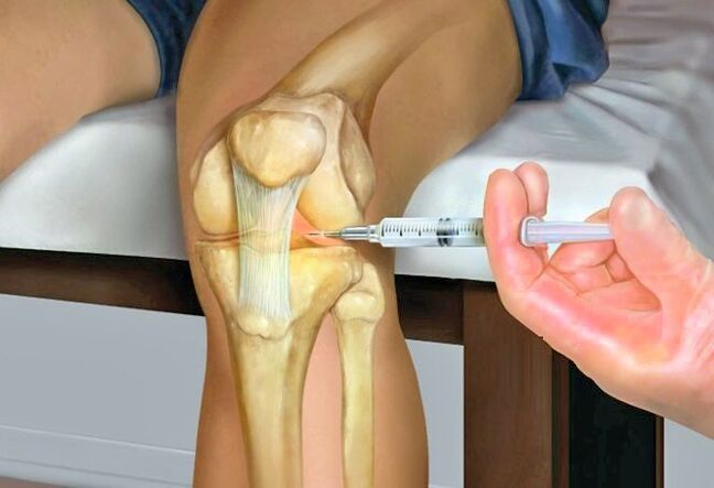 Behandeling van artrose van het kniegewricht