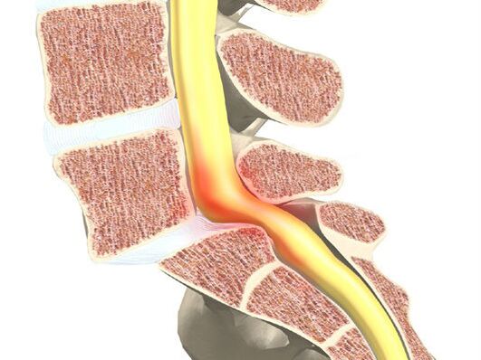 Bloedmotor segment voor osteochondrose