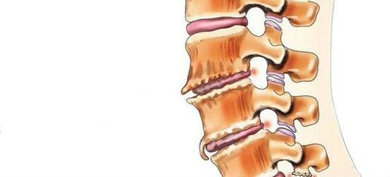 Spondylose - vernietiging van tussenwervelgewrichten