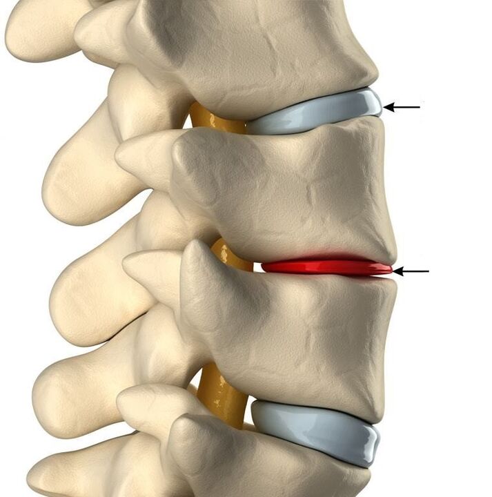 verschil tussen een gezonde tussenwervelschijf en een tussenwervelschijf met osteochondrose