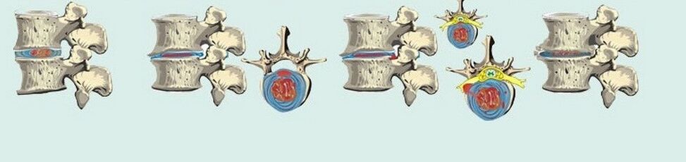 verschillende stadia van thoracale osteochondrose