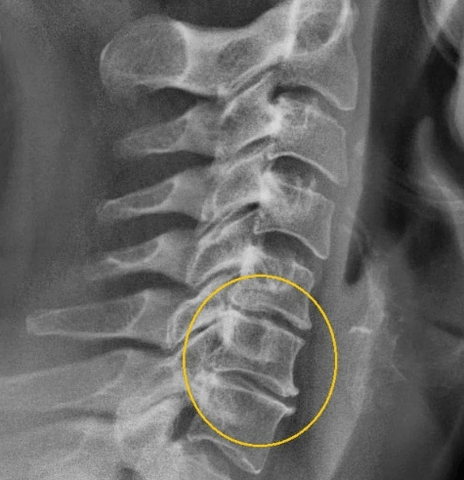 cervicale osteochondrose