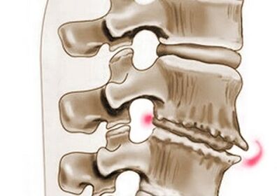 schade aan de wervels bij thoracale osteochondrose