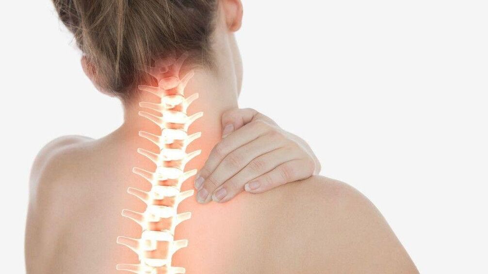 Bij osteochondrose van de cervicale wervelkolom kan zich een radiculair syndroom ontwikkelen