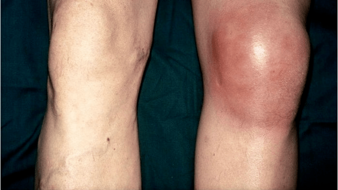 artrose en artritis