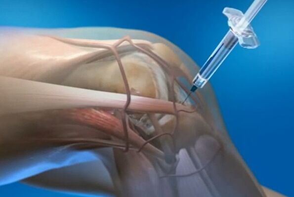 intra-articulaire injecties voor artrose van het kniegewricht