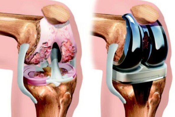 voor en na artrose van het kniegewricht voor artrose